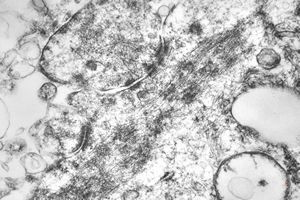 F,45y. | myo-fibrosarcoma - thigh